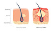 Inflamed hair follicle medical scheme zoomed