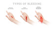 Three main types of bleeding