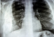 Plain X ray for a patient with aspiration pneumonia right lung, empyema, pleural effusion after insertion of a chest thoracostomy tube to drain the pus and the fluids with a slight improvement