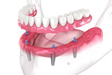Fototapeta Kosmos - Dental prosthesis based on 4 implants. Dental 3D illustration
