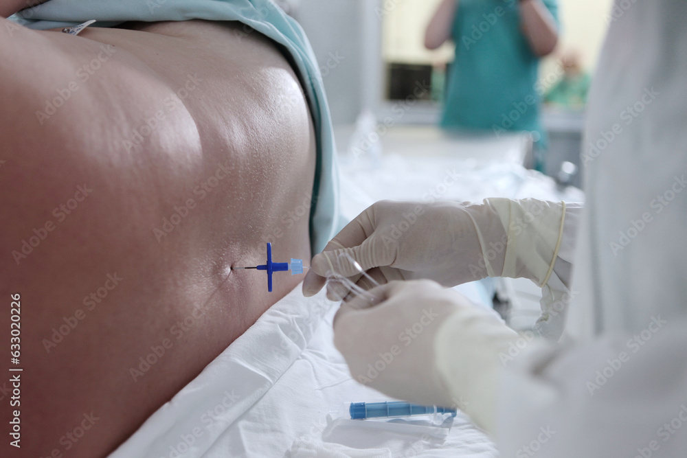 Injections of spinal anesthesia.Injections of epidural anesthesia in ...