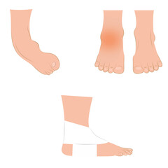 Dislocation of the foot. Illustration on transparent background