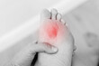 Close up black white photo of woman's foot sole with painful callus with red point. Female is suffering from pain due to corn on leg. The problem is due to tight shoes. Healthcare and medicine concept