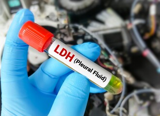 Pleural fluid for LDH test. LDH is a marker of inflammation or cellular injury or TB.  lactate dehydrogenase