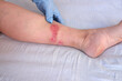 © kittyfly - doctor treats large healing wound from on lower leg with scars of adult female patient, redness, scarring of skin, concept of medical care, health care, human tissue regeneration, scald on women feet
