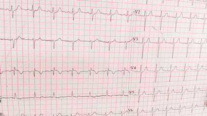 Wall Mural - ECG pulse rate paper that shows sinus rhythm abnormality of right ventricular hypertrophy. Cardiac fibrillation. Normal sinus rhythm ECG. Vital sign. Medical healthcare symbol.