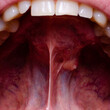 A tumor in the oral cavity of an adult, close-up. dental problems.