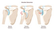 Shoulder dislocation types. Arm injury, upper arm bone pops out of the cup