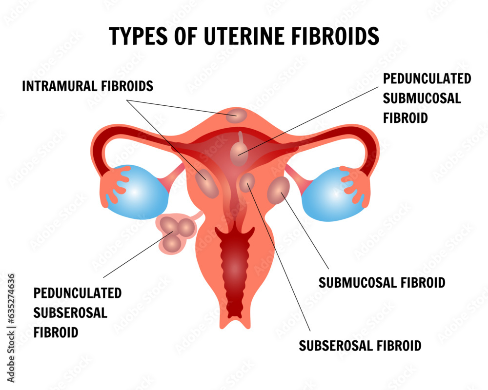 Fibroid Structure Medical infographic, gynecology types of uterine fibroids Stock Vector ...