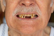 © Andrii Iemelianenko - Close-up macro shot of toothless male smile mouth of senior mature man. Dental problem, bad teeth loss. Pensioner grandfather guy showing rotten teeth, caries, decayed, weak enamel, teeth falling out