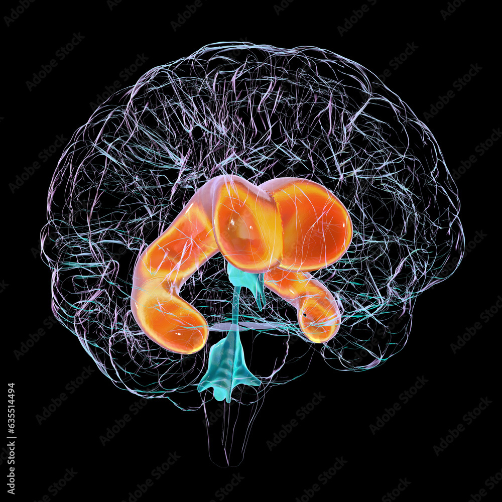 Enlarged lateral ventricles of the brain, 3D illustration Stock ...