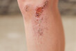 two scratch wound on female knee with big scar closeup, healthcare and medicine concept.