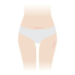 © Mosterpiece - The woman with keloid scars on belly and thigh vector illustration isolated on white background. Keloid scar, raised scar on her body after having a cesarean section, hysterectomy and skin injury.