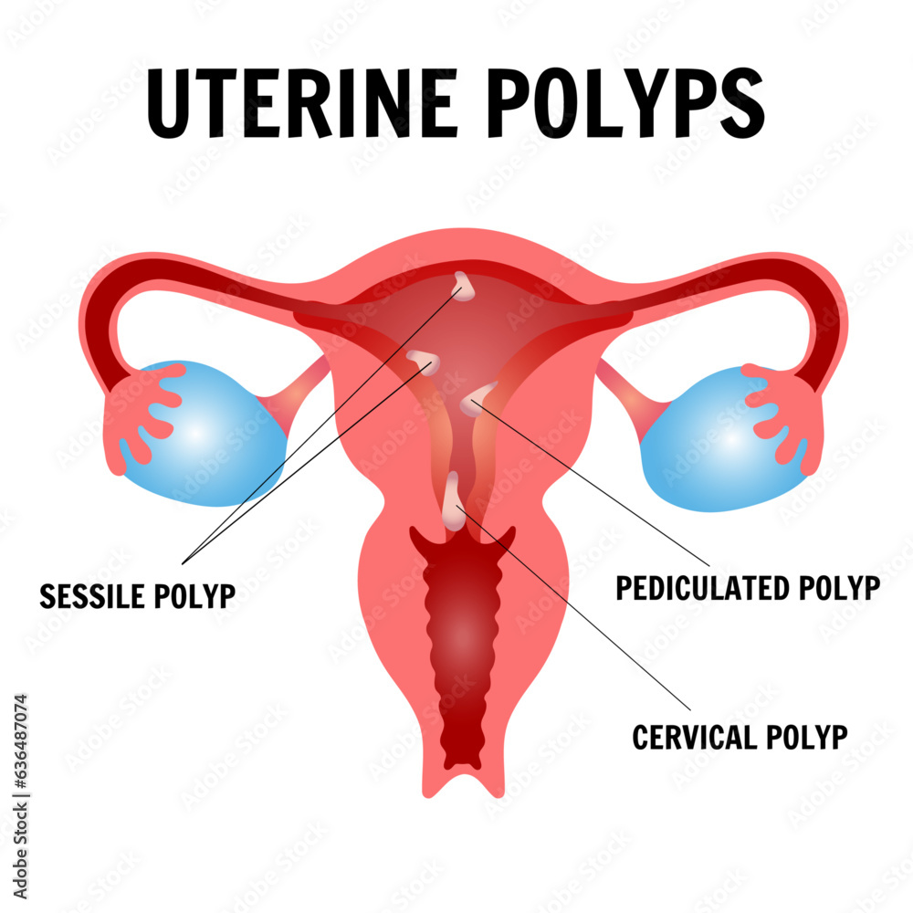 Uterine polyps infographic, sessile polyp, pediculated polyp, cervical polyp