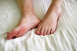 female legs with problem with women's feet, bunion toes in bare feet. Hallus valgus