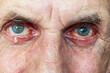 © fotosenukas - Sick eyes of an adult man with tears
