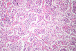 Lobar pneumonia in red hepatic phase, light micrograph