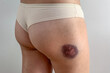 hematoma on the skin of the leg due to a blow to the leg of a woman close-up
