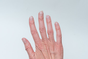 Wall Mural - Close-up of a woman's age-old hand with wrinkles with natural nails, overgrown cuticle. Crooked fingers, gout.