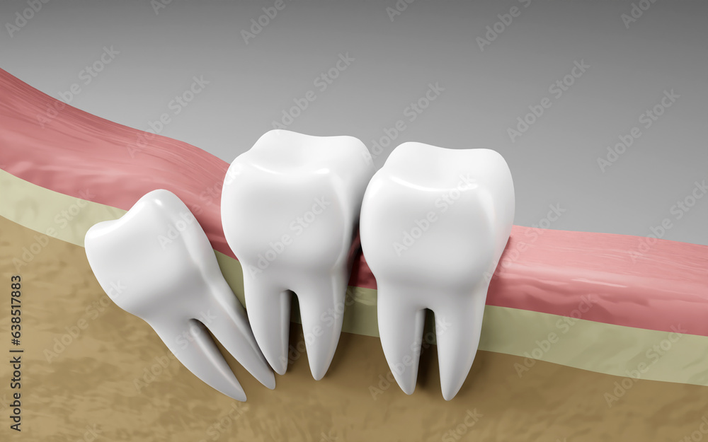 Wisdom tooth impaction. Oral health and dental inspection teeth ...
