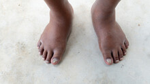 Above View Of Swollen Feet On Both Sides. Health Problems Of The Elderly. Stand Barefoot On The Concrete Floor.