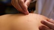 Akupunktur beim Heilpraktiker - feine Nadeln stimulieren die Akupunkturpunkte auf der Haut. 
