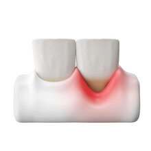 front teeth and gums recession or gingivitis 3D rendering.