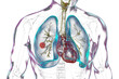 Lung cancer, 3D illustration