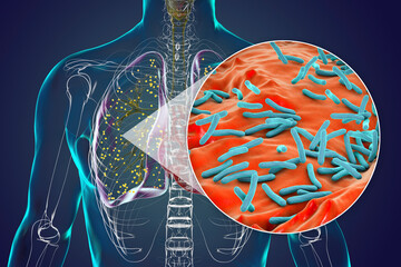 Sticker - Human lungs affected by miliary tuberculosis, with a close-up view of the Mycobacterium tuberculosis bacteria, 3D illustration