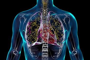 Wall Mural - Human lungs affected by miliary tuberculosis, 3D illustration