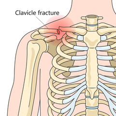 Canvas Print - Clavicle fracture broken collarbone structure diagram schematic vector illustration. Medical science educational illustration