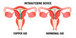 Copper IUD and hormonal IUD intrauterine device