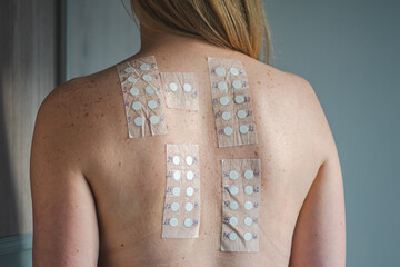 patch test on the naked shoulder and back of a young blonde hair girl. allergy patch testing is used