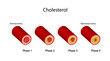 © PH-HY - Atherosclerosis, normal artery versus narrowed artery blocked with cholesterol plaque. Blood vessel blocked with a clot. High cholesterol level as atherosclerotic risk. Vector illustration.