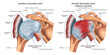 Medical illustration shows the difference between a normal shoulder joint and a frozen shoulder joint, with annotations.