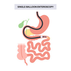 Poster - Single balloon enteroscopy