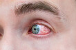 Man with red eye, macro shot. Conjunctivitis infection. concept of eye disease, Allergic conjunctivitis hyperemia