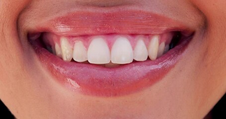 Sticker - Woman, lips and teeth whitening with veneers for dental closeup, smile and happiness on face for health. Orthodontics, beauty glow and cosmetics with mouth and oral care for grooming and hygiene