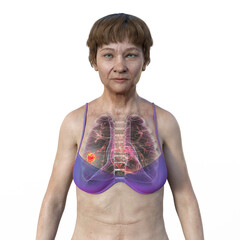 Sticker - A 3D illustration of a woman with transparent skin, revealing the presence of lung cancer.