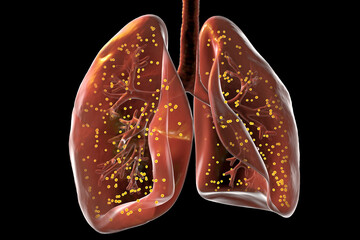 Sticker - Human lungs affected by miliary tuberculosis, 3D illustration