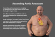 An obese man with ascending aortic aneurysm, 3D illustration