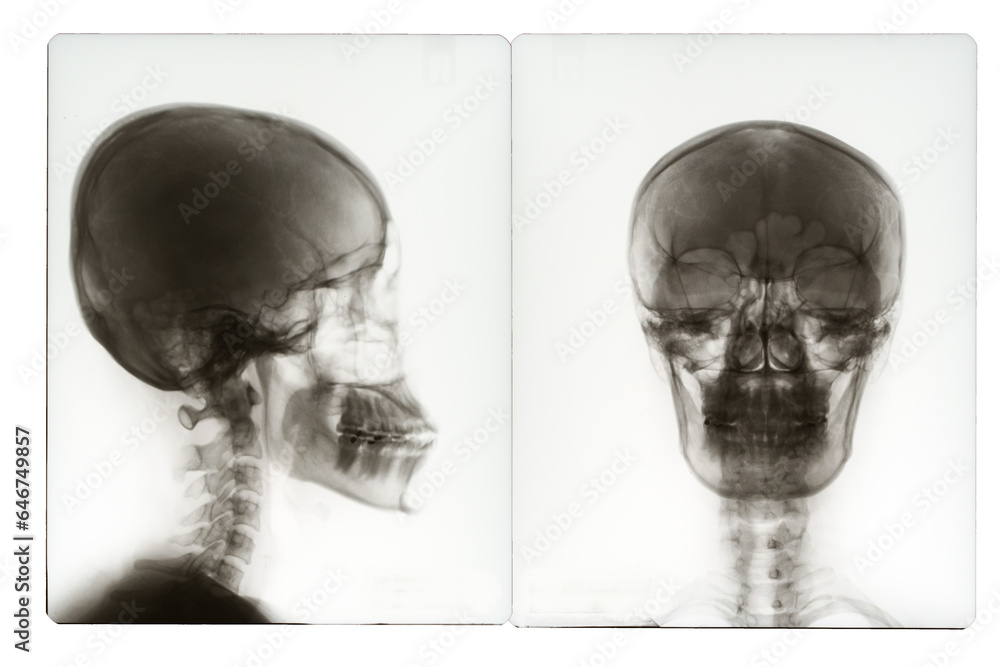 X ray image of human skull Stock Photo | Adobe Stock