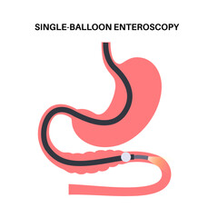 Poster - Single balloon enteroscopy