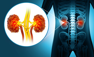 Wall Mural - Chronic kidney disease. 3d illustration