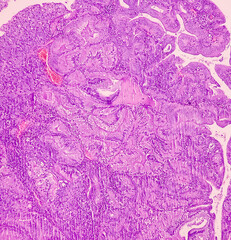 Poster - Endometrial adenocarcinoma. Uterus cancer. Uterine papillary serous carcinoma (UPSC). Show endometrial tissue of serous papillary type-(G-2).