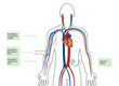Different types of dialysis illustration. Man body illustration with all types of catheter for hemodialysis 