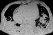 X- ray image showing bilateral pneumonia. Medical themes