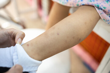 Little child girl with a scars,dark spots on leg from mosquito allergy, infection of an insect bite,a mark left on skin of her legs,skeeter syndrome,disease of poor lymph disorder,bad lymph sickness