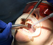© Oleksandra - professional teeth cleaning in a dental clinic, removing stones and plaque, young specialists working with a woman, cleaning a saliva ejector, sucking out saliva, applying paint to the teeth