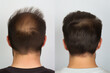 canvas print picture - Generative AI collage two photos comparison before after anti hair loss procedure hair treatment